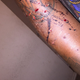 Another photo showing bite marks on Marlin Gipson’s arm, according to attorney Lee Merritt (courtesy of Lee Merritt)